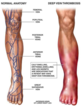 Vein Specialist at Lafayette Regional Vein and Laser Center Educates...